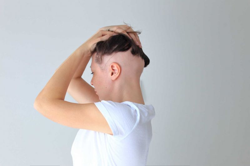 Alopecie: její příčiny, příznaky a léčba